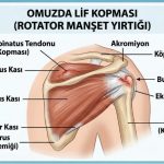 Omuz Problemlerinde Artroskopik Tedavi: Yırtık ve Sıkışma Sorunlarında Modern Yaklaşım